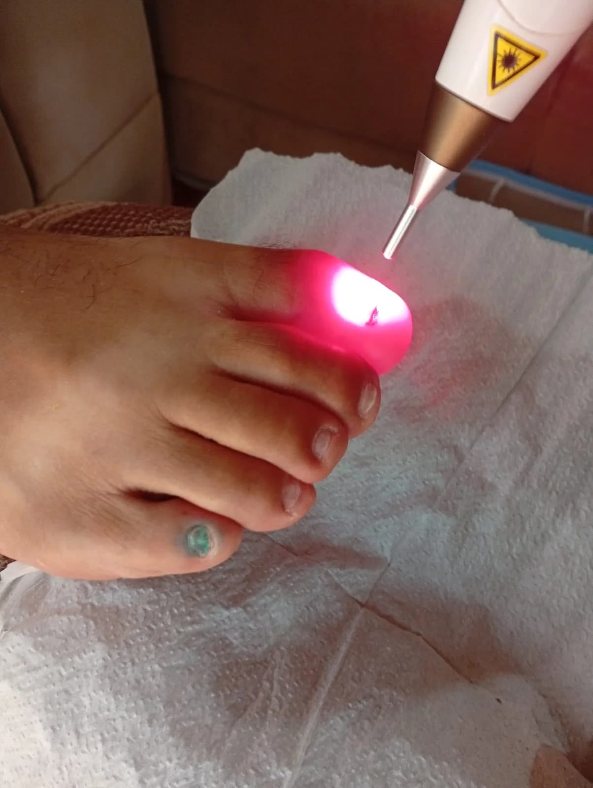 Tratamento Unhas Encravada, Fungos