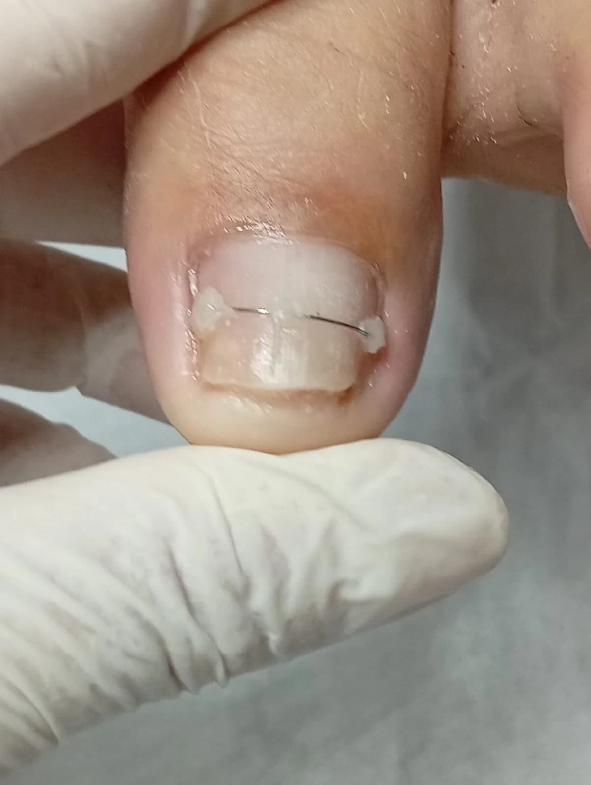 Tratamento Unhas Encravada, Fungos - imagem 2